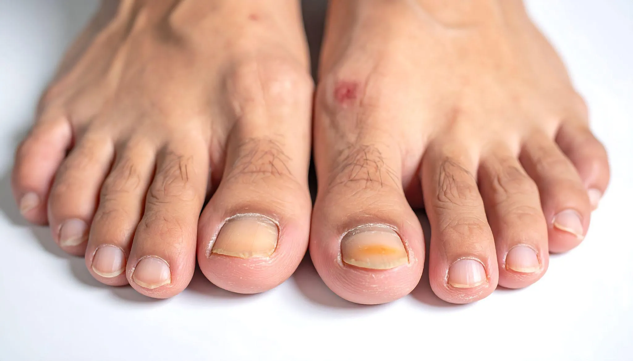 糖尿病の初期症状として現れる爪の変化