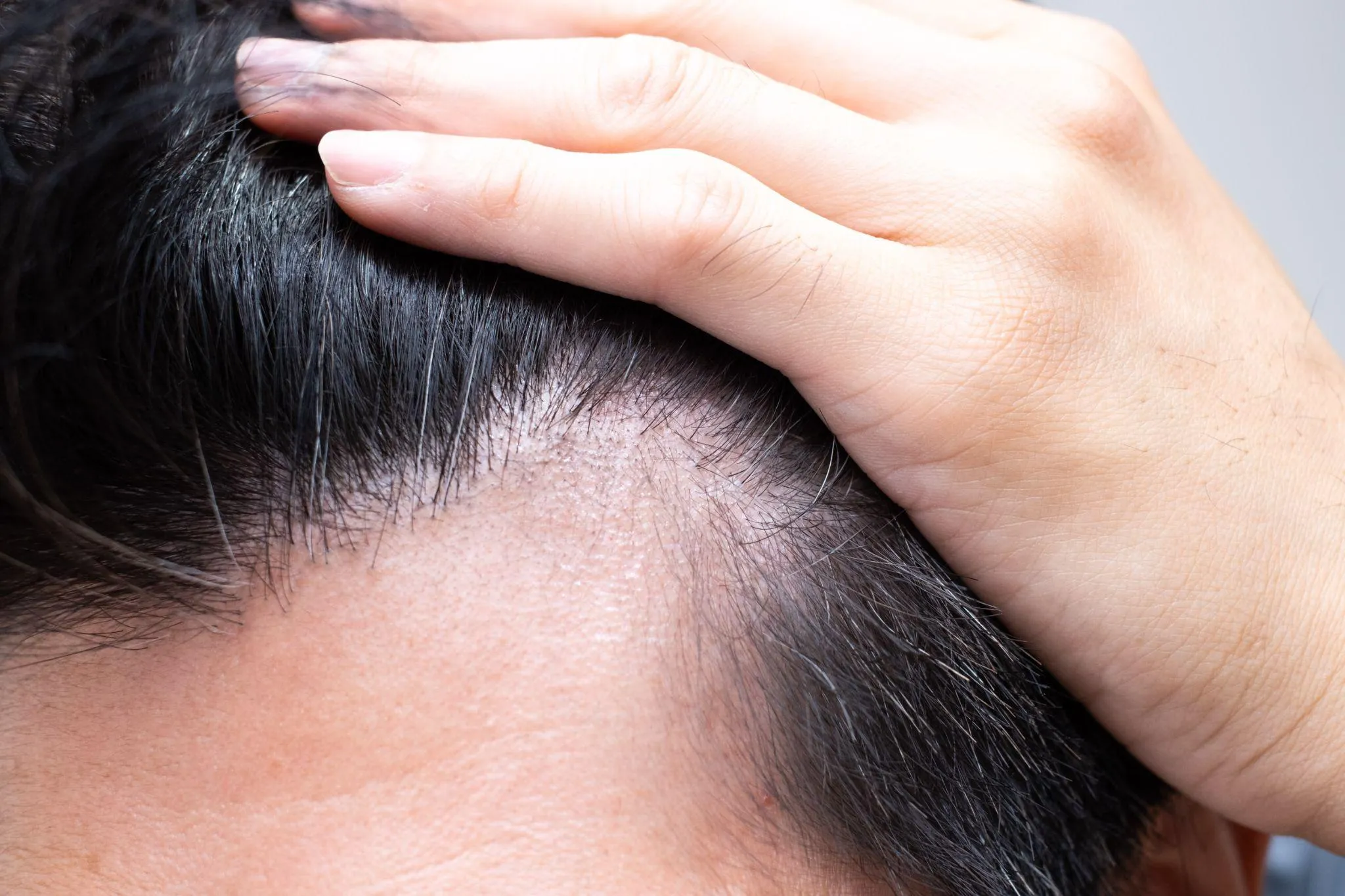 AGA治療は効果がない？効果が出ない人に見られる特徴とは
