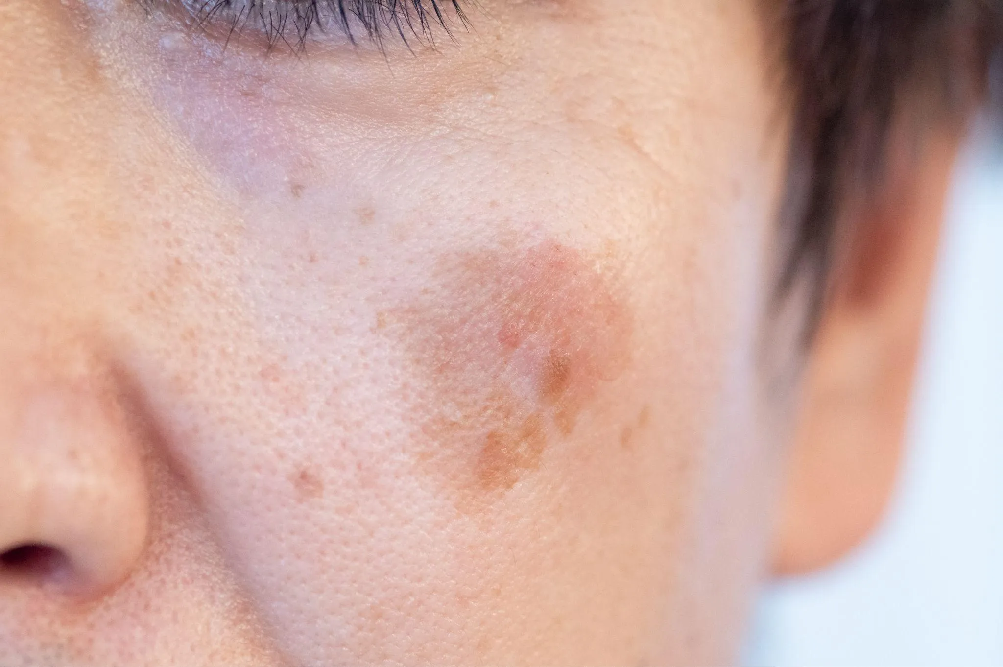 IPL光治療の注意点