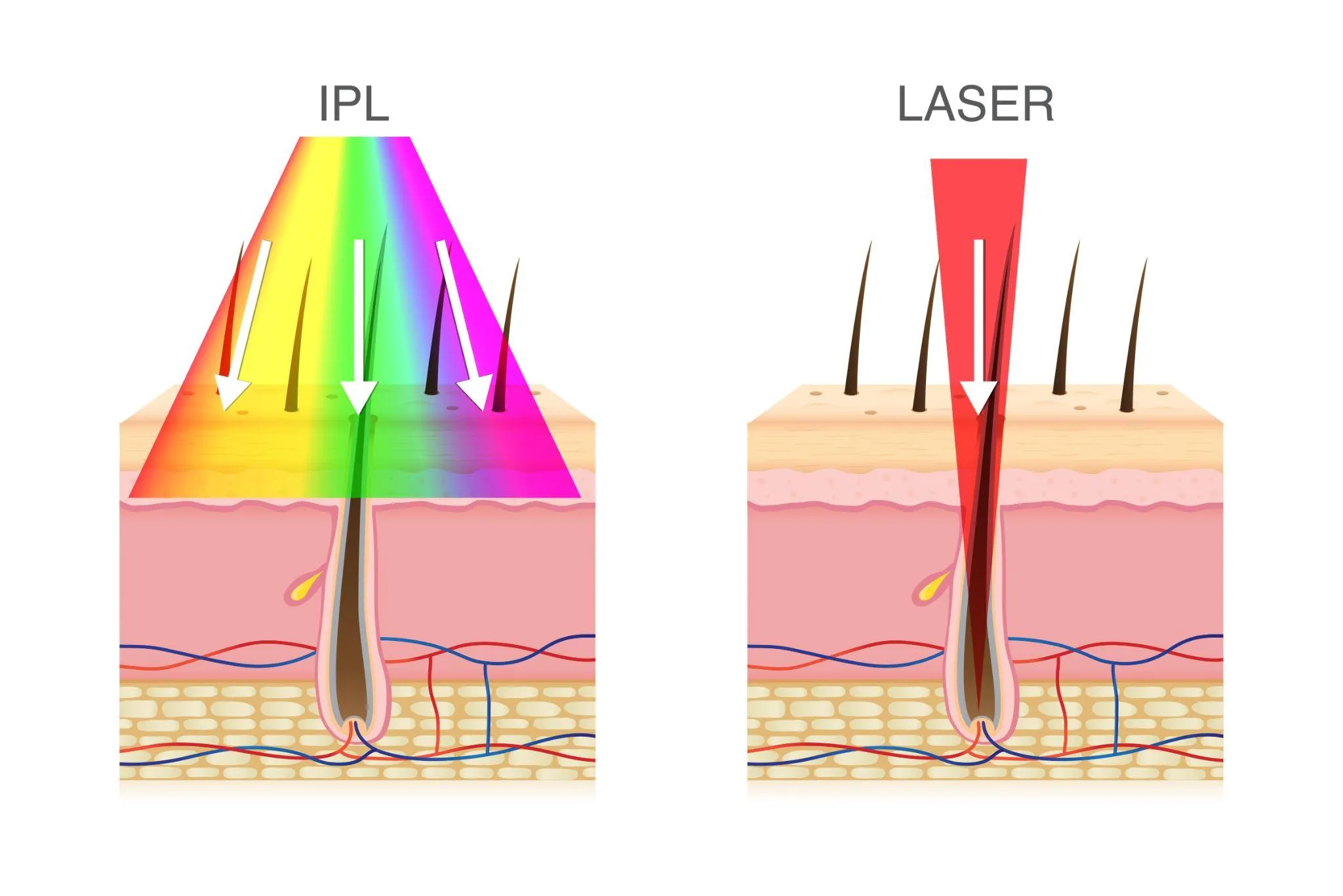 IPL光治療とレーザーの違い