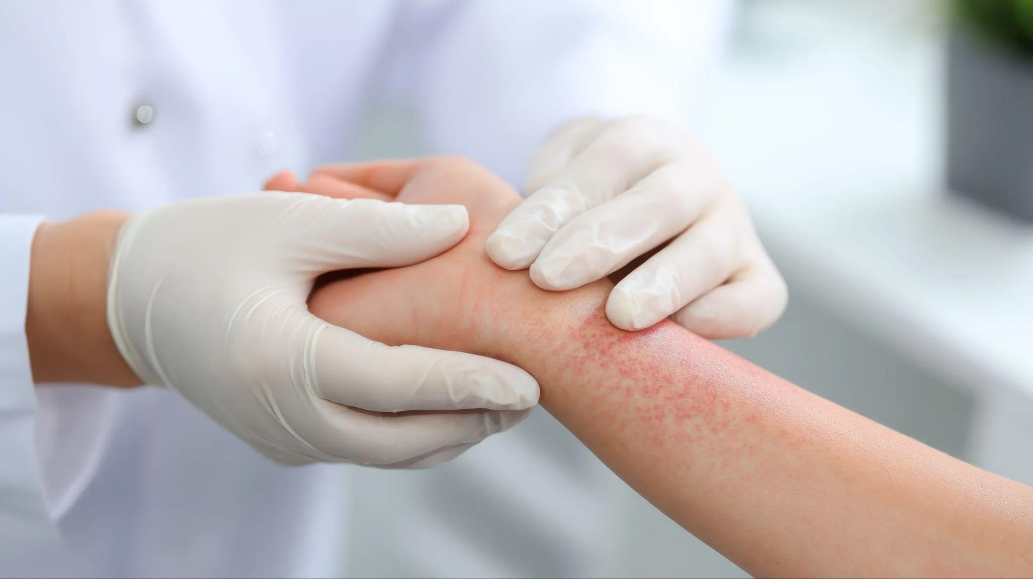 当院のアトピー性皮膚炎の治療について