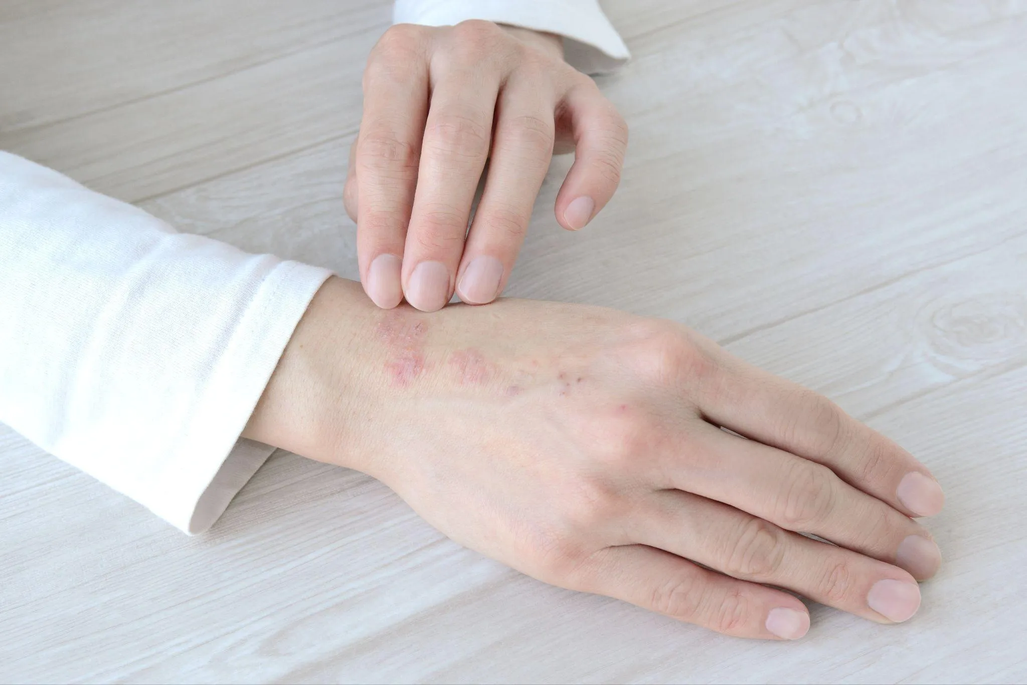 【大人のアトピー性皮膚炎】原因と治療法を解説