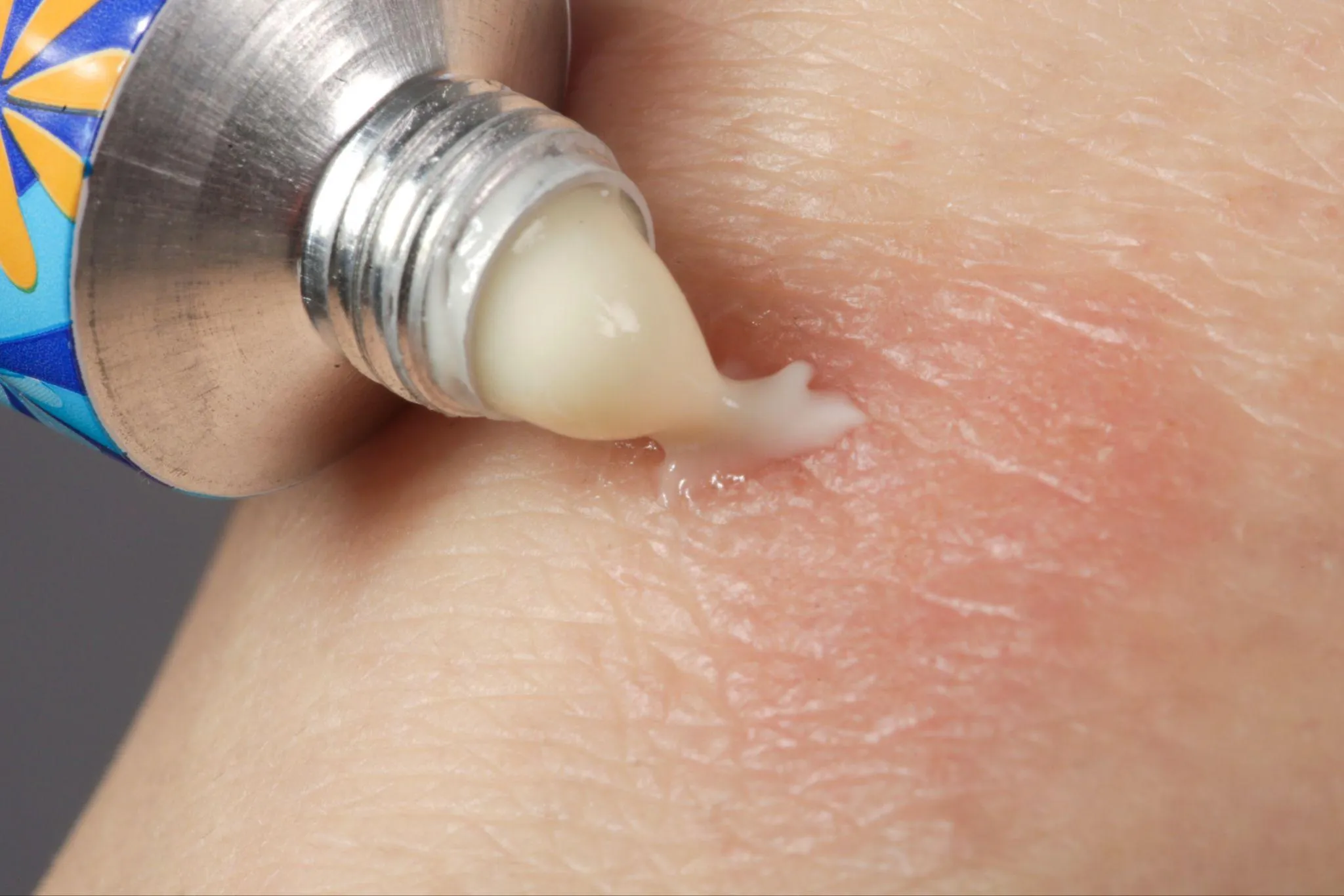 大人のアトピー性皮膚炎の治療法