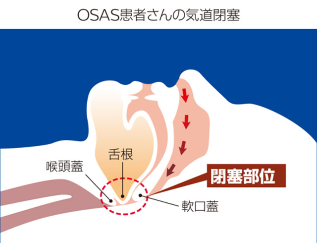 OSAS患者産の気道閉塞