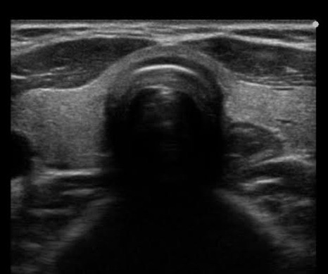 正常な甲状腺超音波検査画像